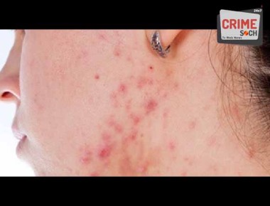 acne-and-dark-skin-10-steps-to-remove-blemishes-scars-and-spots-580x3155414649878